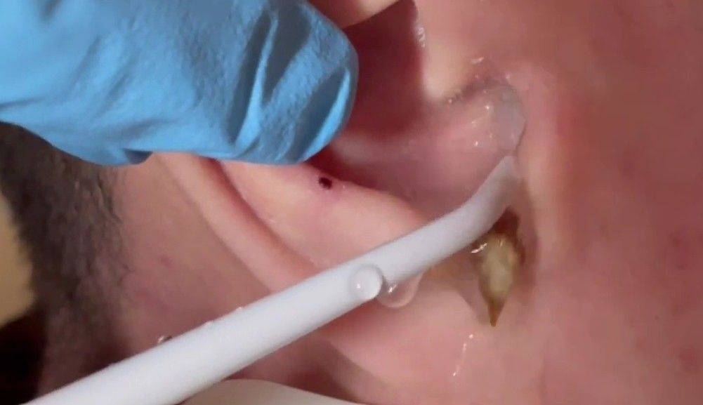 performing ear syringing in  Happy Ears Ear wax removal clinic in Grimsby