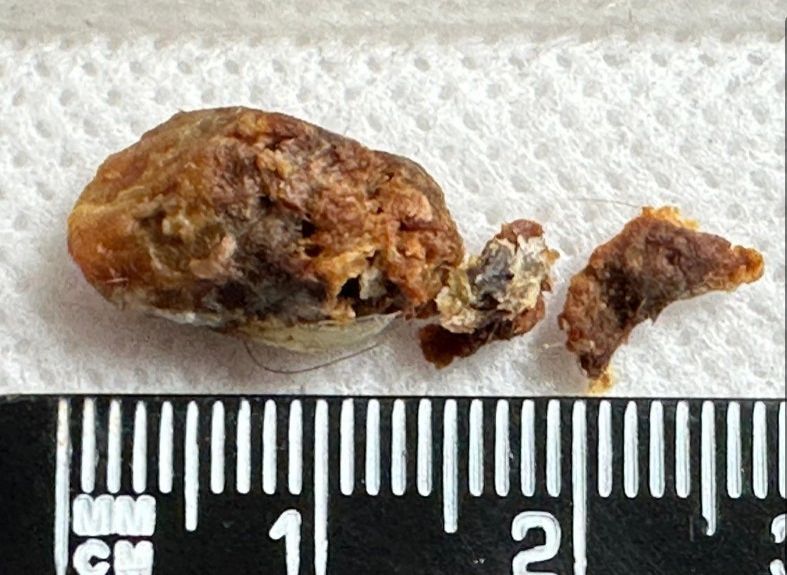 ear wax removed from an ear using irrigation
