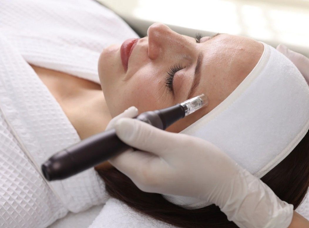 microneedling a client in nottingham