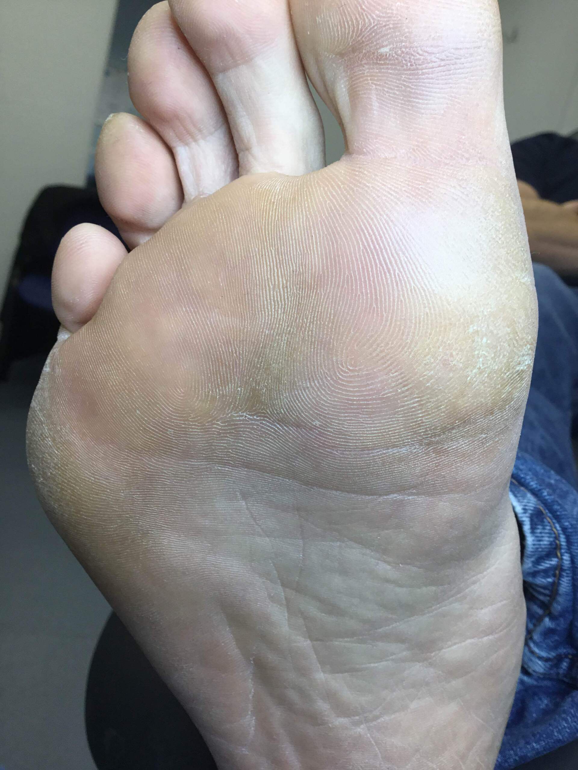 Swift Verruca Treatment Whitley Bay Bay Podiatry