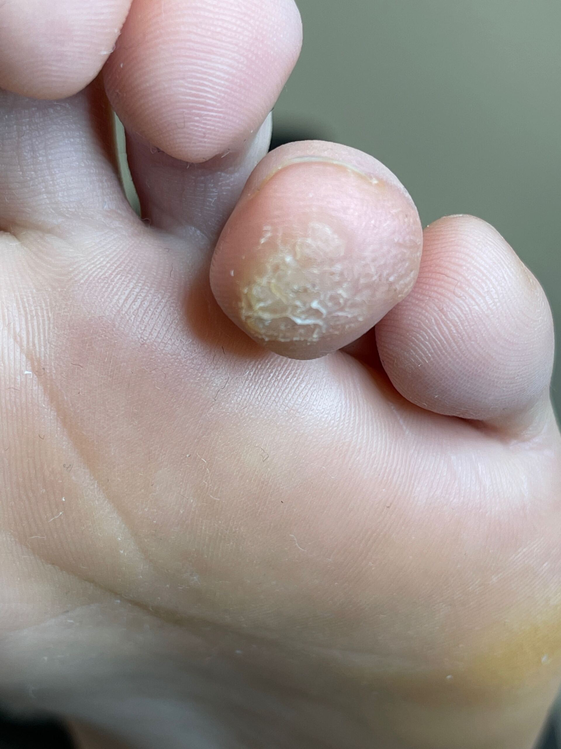 Swift Verruca Treatment Whitley Bay Bay Podiatry