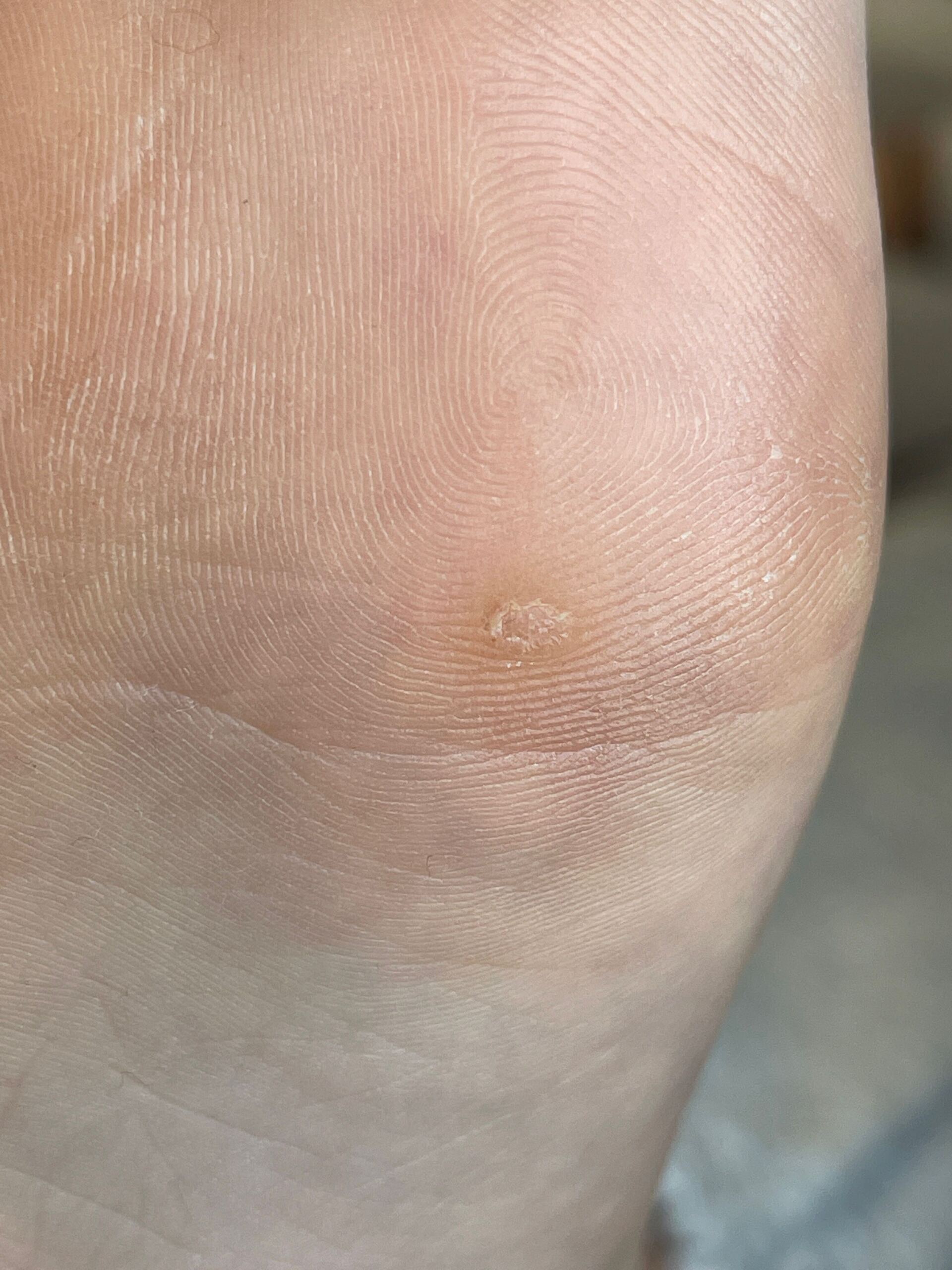 Swift Verruca Treatment Whitley Bay Bay Podiatry