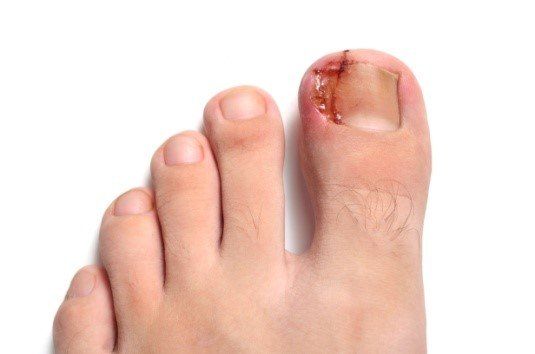 Ingrown toenail treatments | Sally Pembery Associates