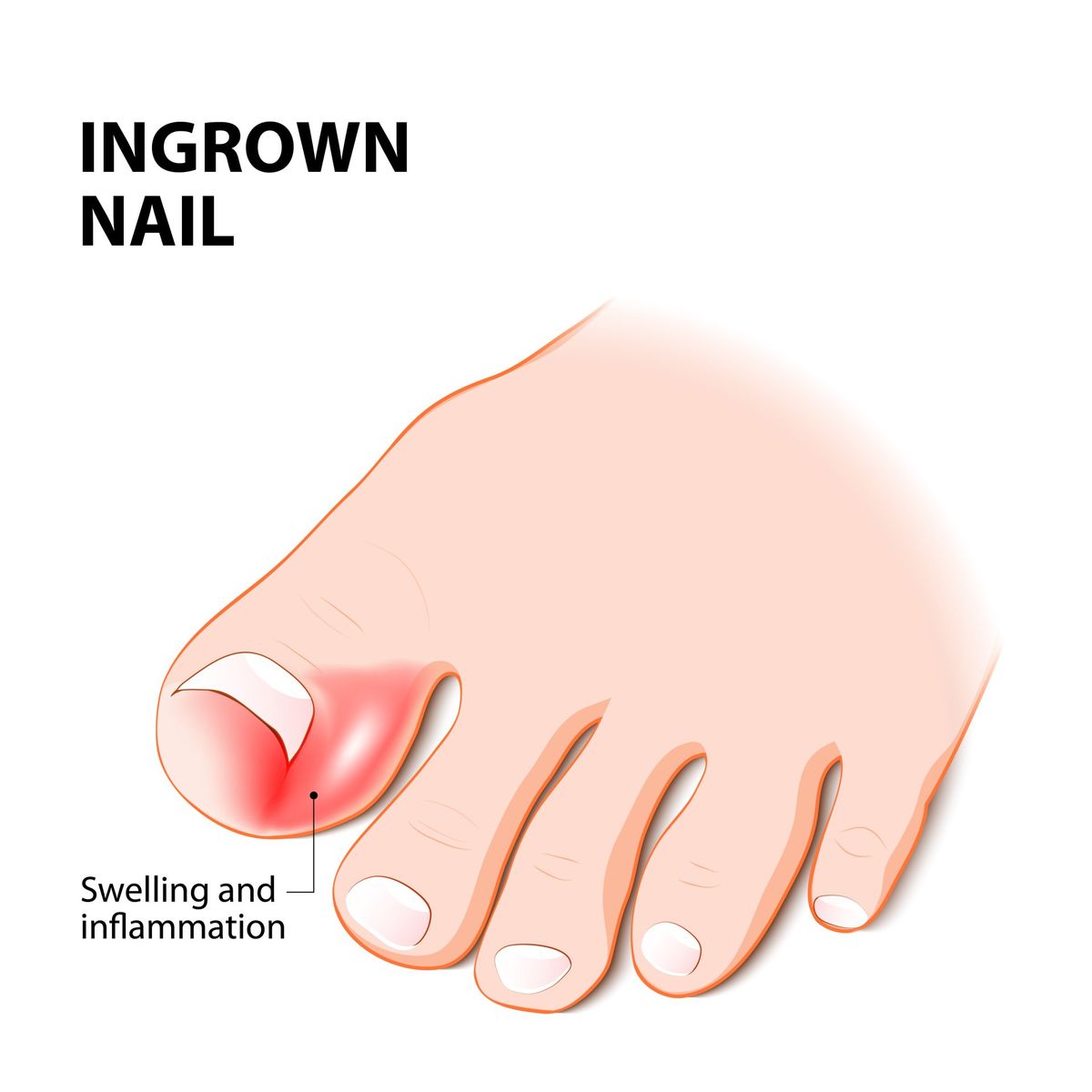 Ingrown toenail treatment