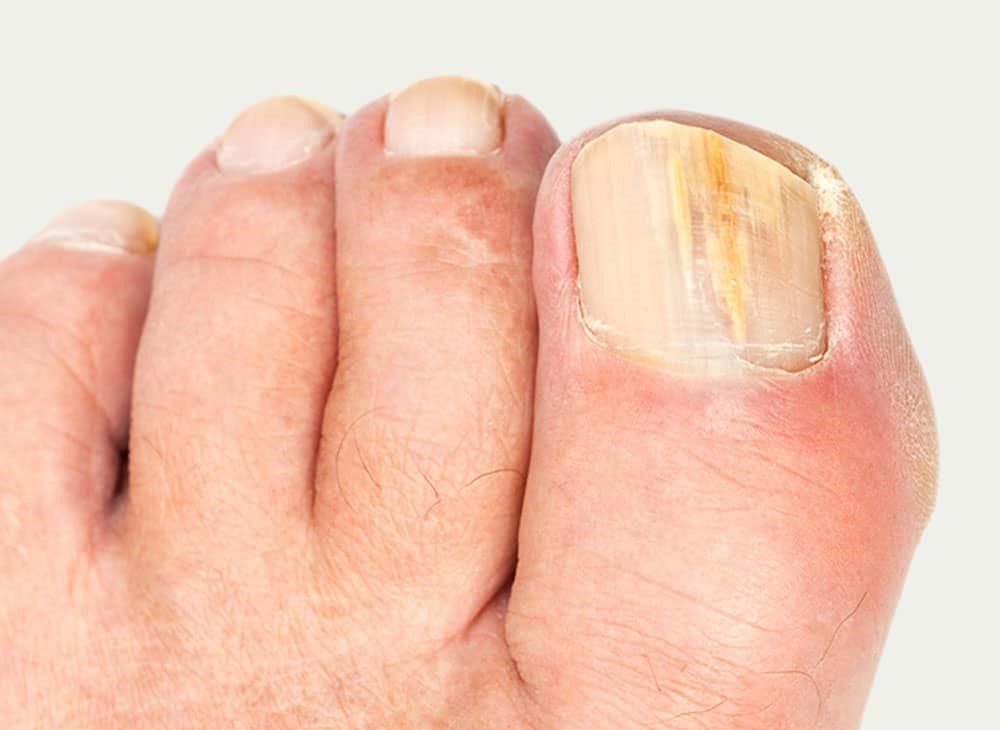 Fungal Nail Treatment