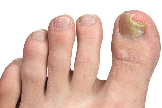 Treatments for Nail Infections