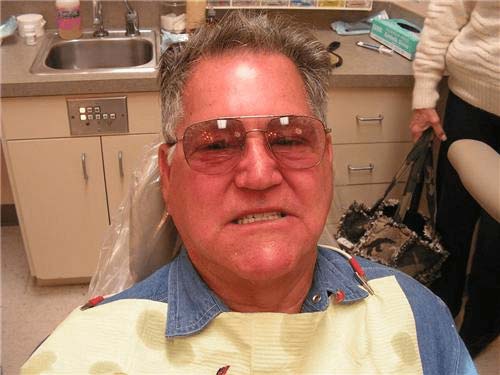  Full upper over full lower.  implant bar overdenture.  Chris Castellano DMD , top implant  dentist , Riverview, Fl. 33578