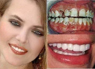 cosmetic dental restoration woman, castellano dmd, riverview fl, castellano dmd