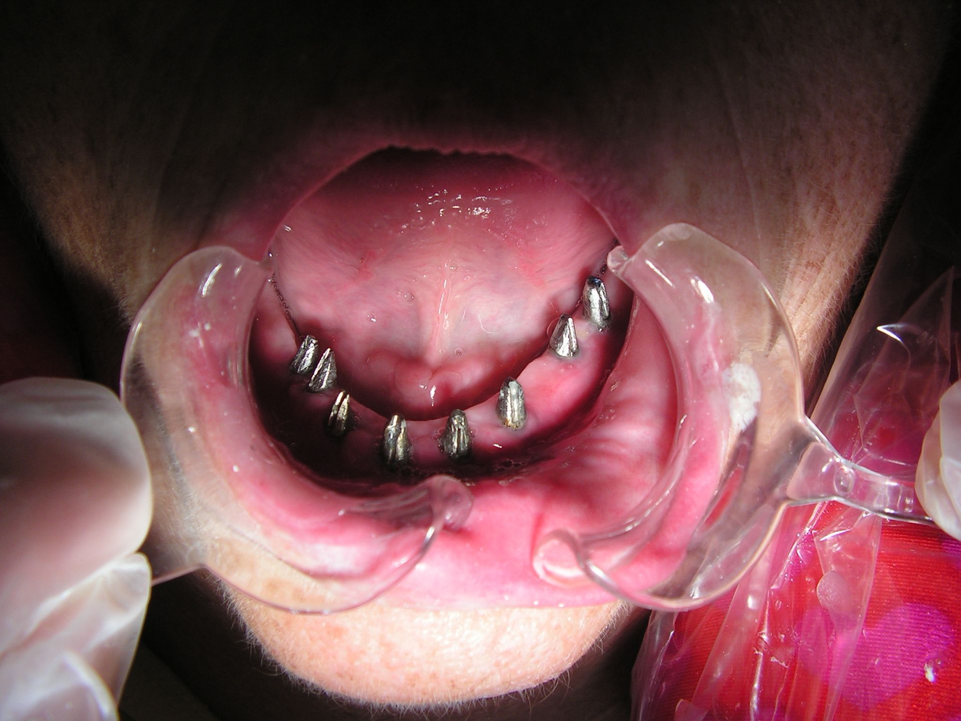 top implant dentist, dentist 33578, implant dental riverview