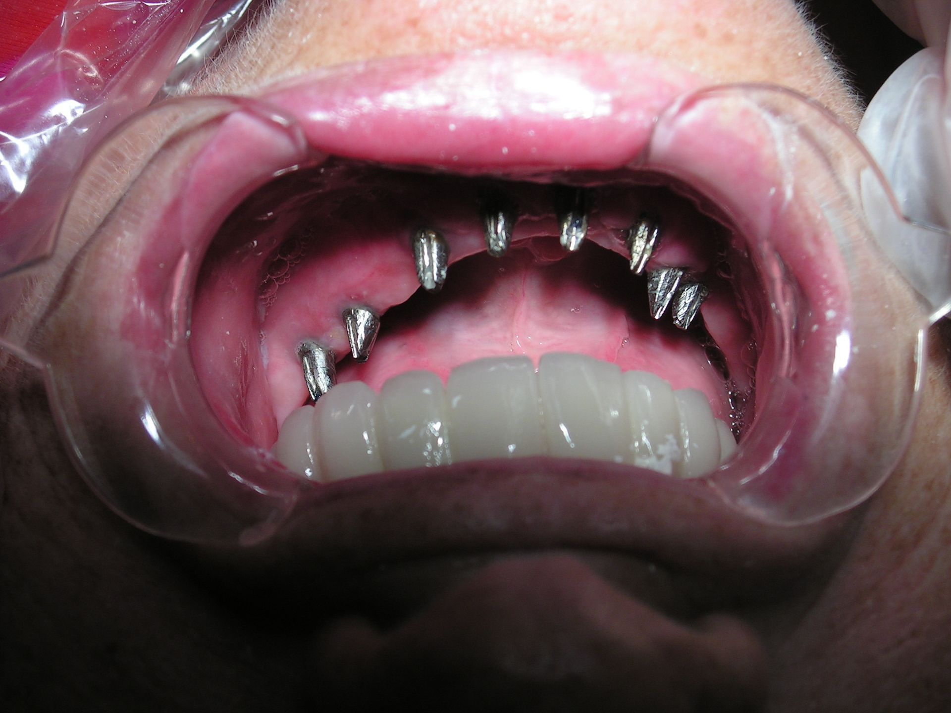 model upside down lower implant abutments prepared.