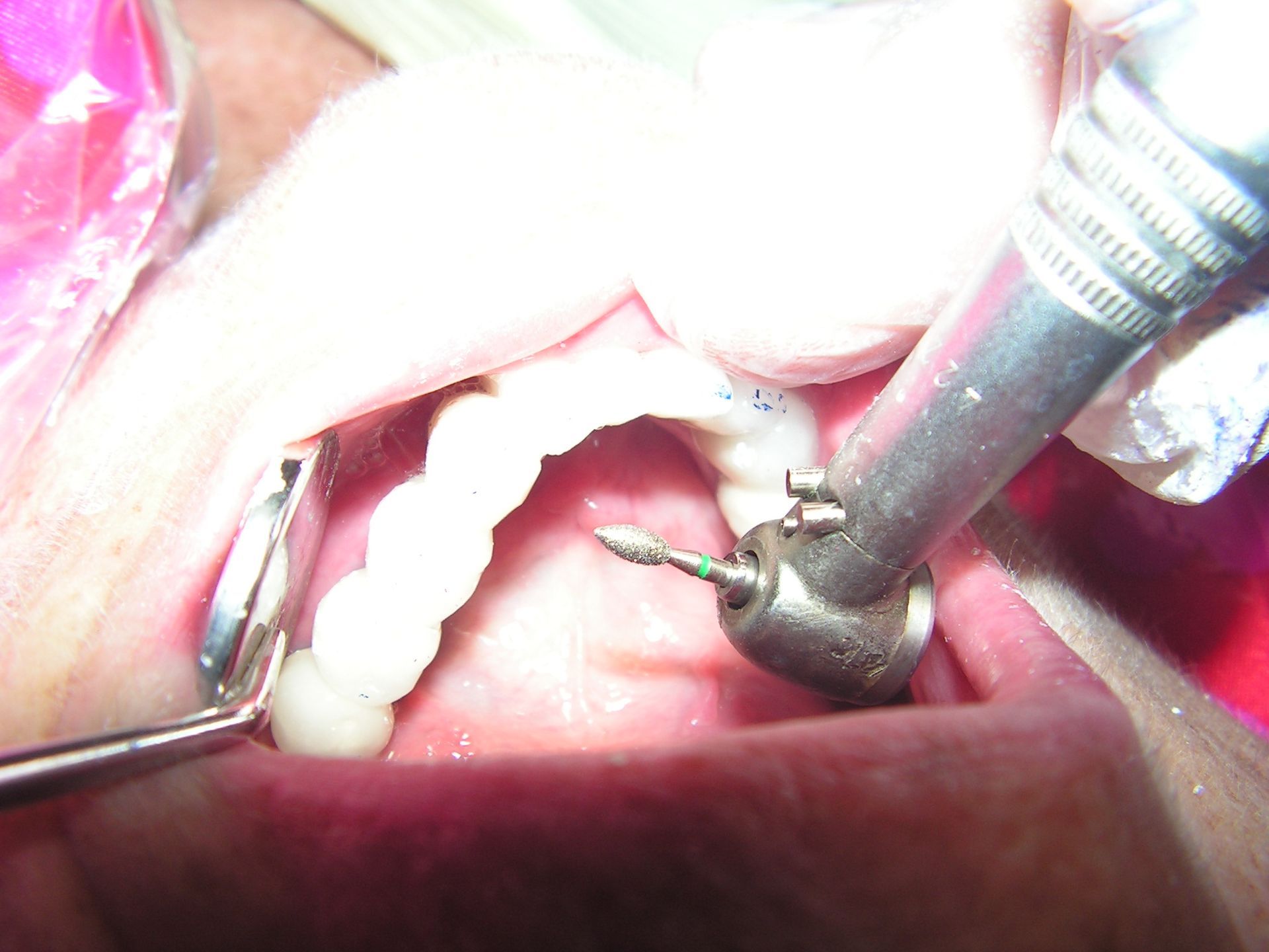 implant restoration 33578, dentist riverview, top implant dentist