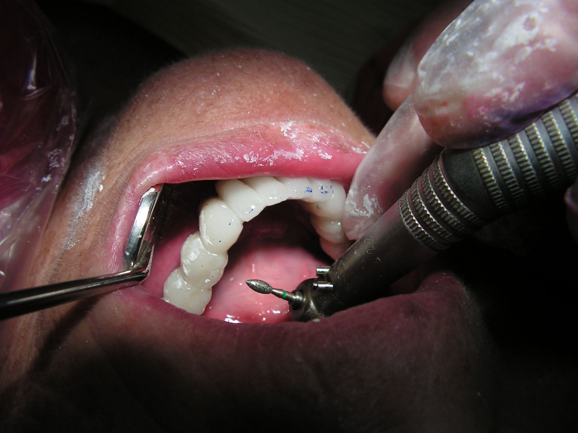 adjusting implant restorations, dental high speed hand piece close up, dentist 33578, riverview dentist, riverview implant dentist