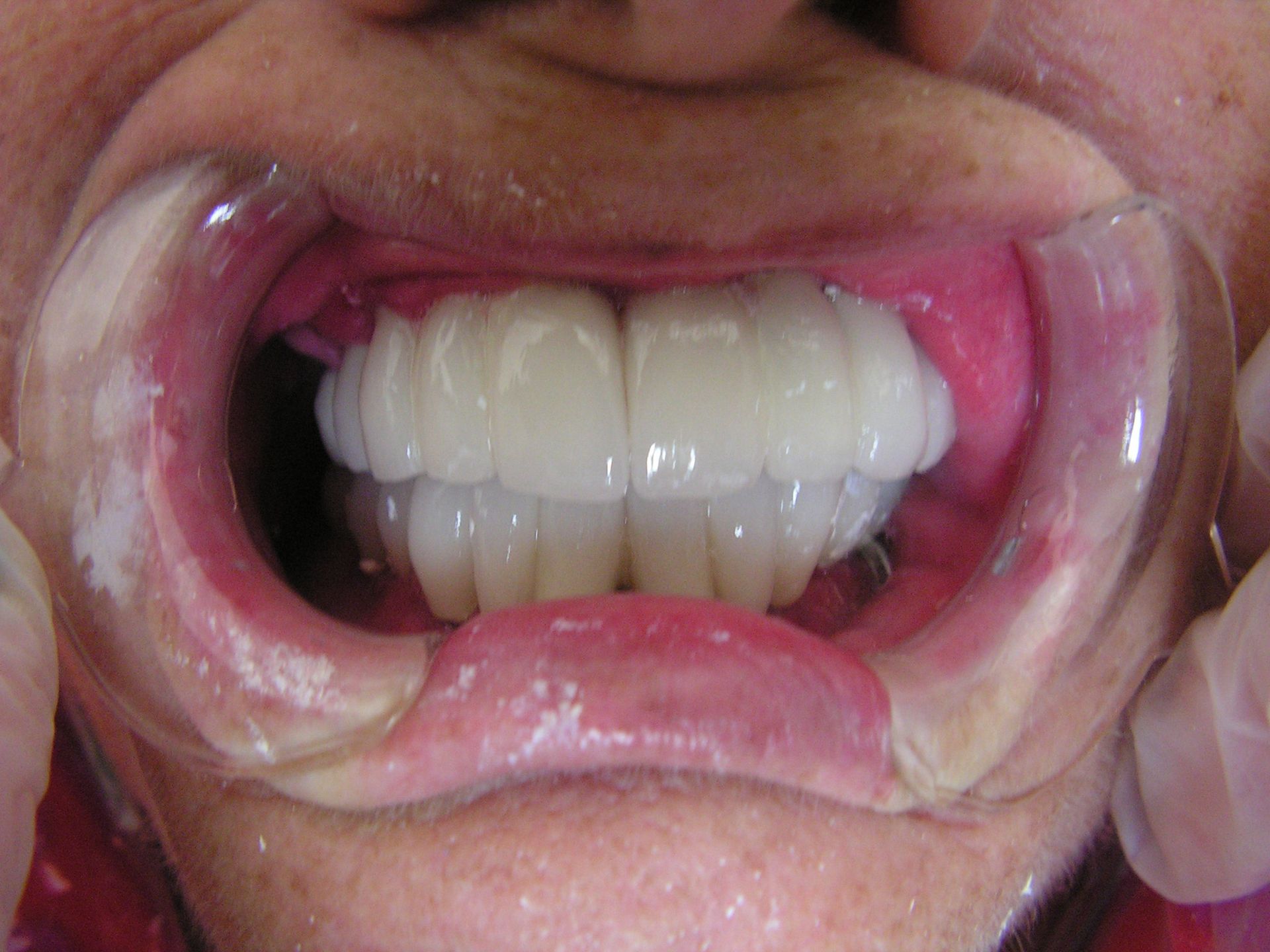 white teeth, implant restorations on atrophic maxilla, top implant dentist, riverview dental implants