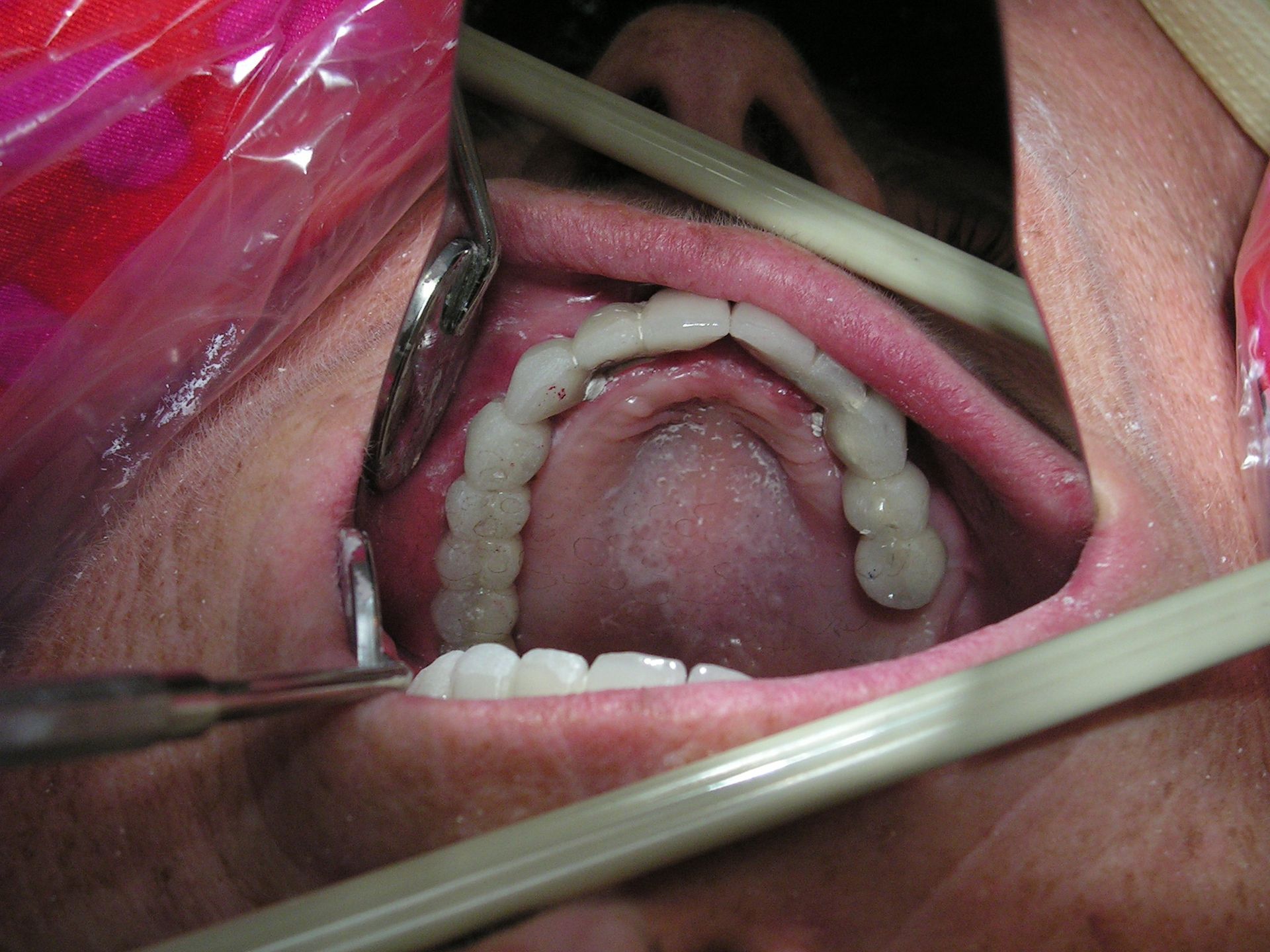 upper arch implants, full mouth implant reconstruction, best dentist 33578