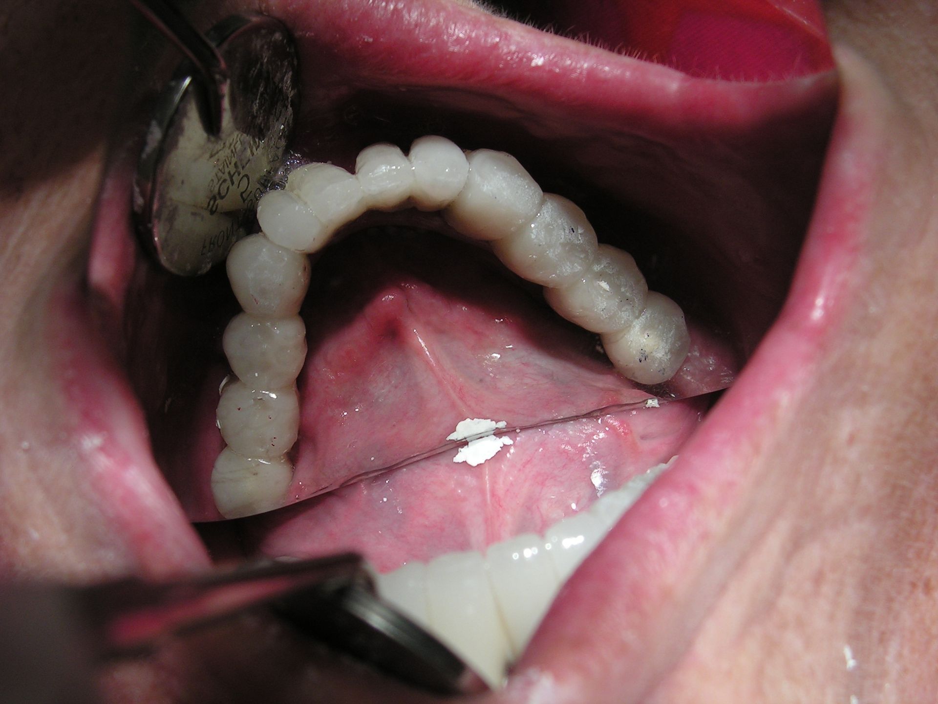 lower arch implant restorations, full mouth reconstruction with implants , dentist riverview, chris castellano dmd