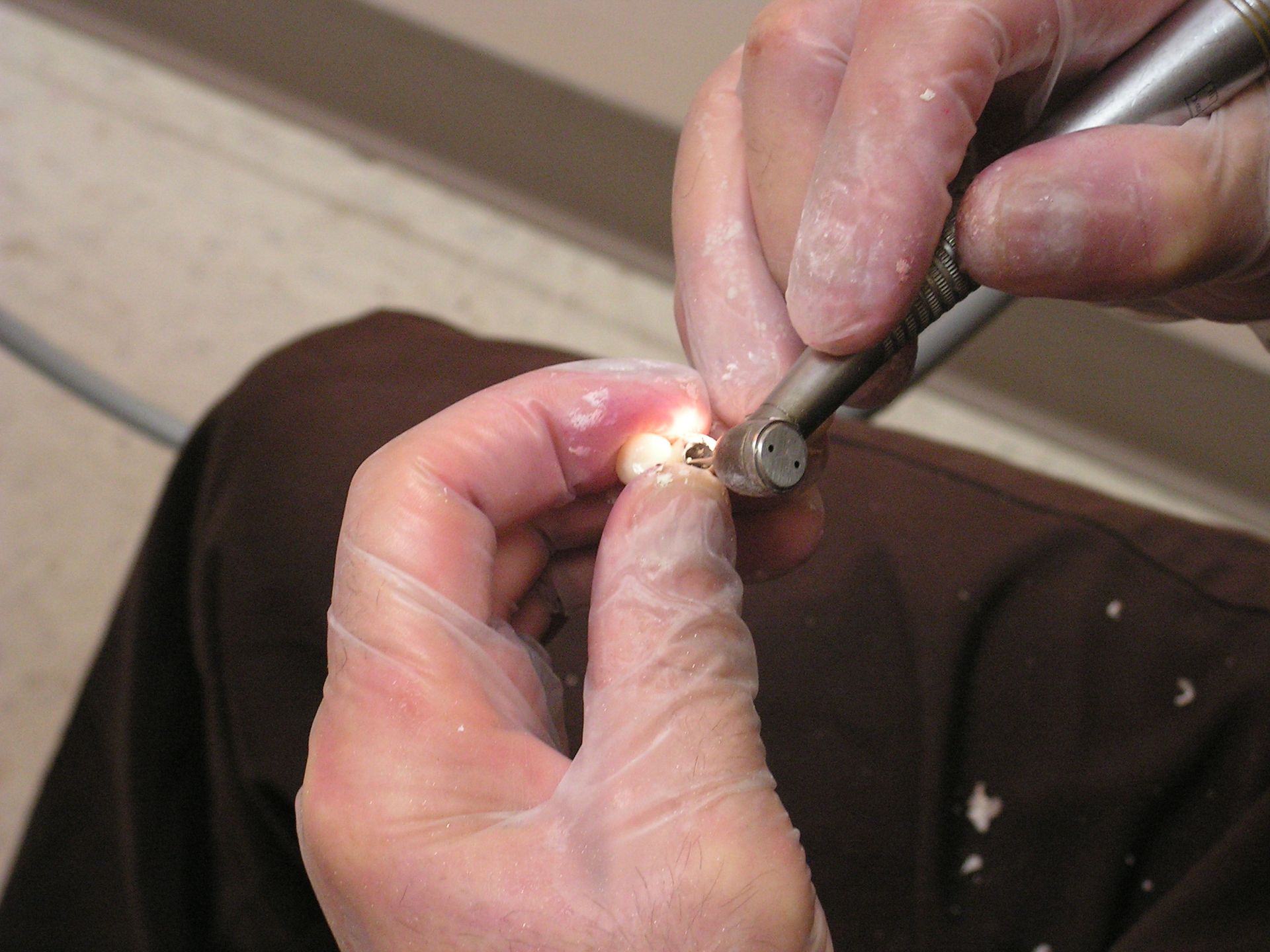 adjusting an implant crown, implant 33578, riverview implant dentistry, chris castellano dmd