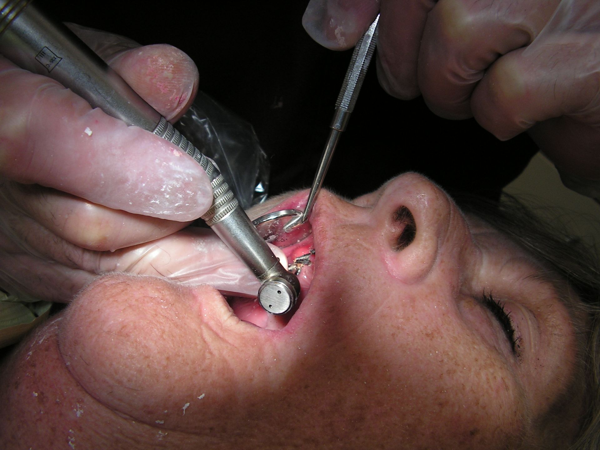 best dentist riverveiw, dentist 33578, , dental implants, full mouth implant reconstruction