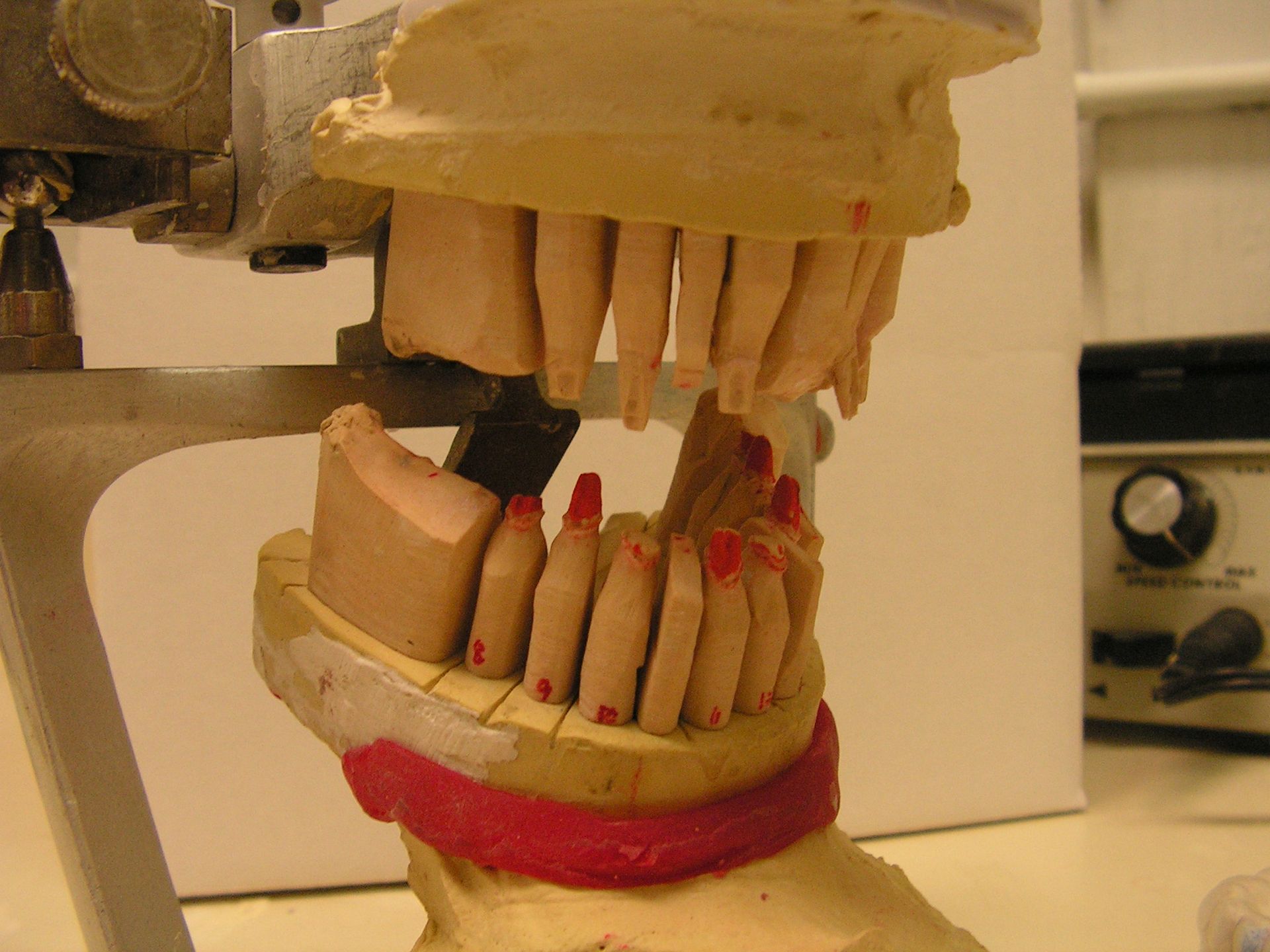 implant dentist, 33578, top implant dentist, articulated implant models, full moutth implant reconstruction
