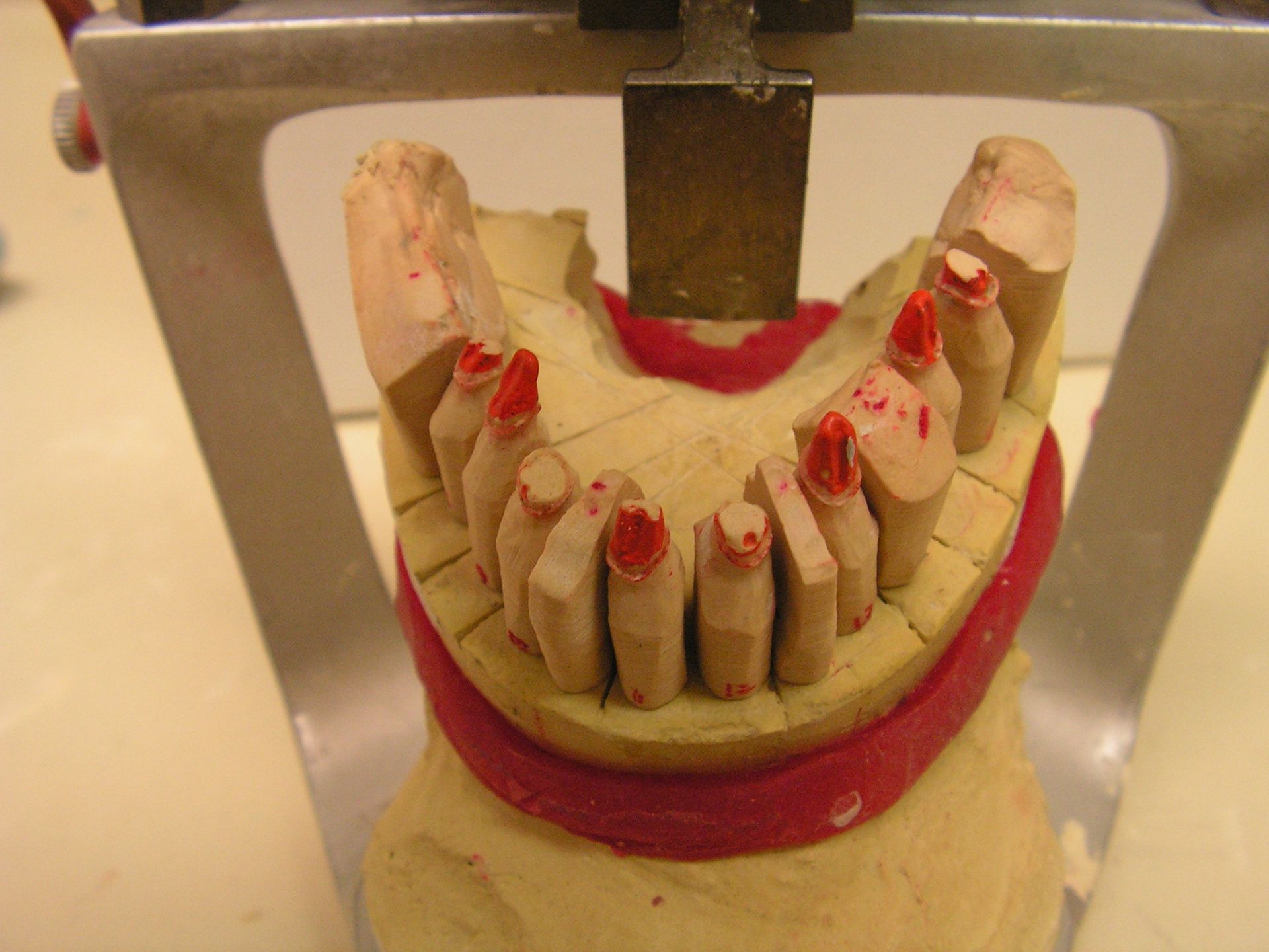 lower stone model, implant reconstruction, dentist riverview, chris castellano dmd, 