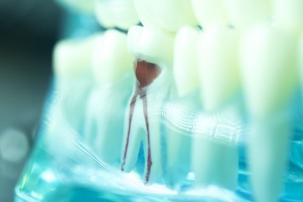 The Basics of What a Root Canal Is