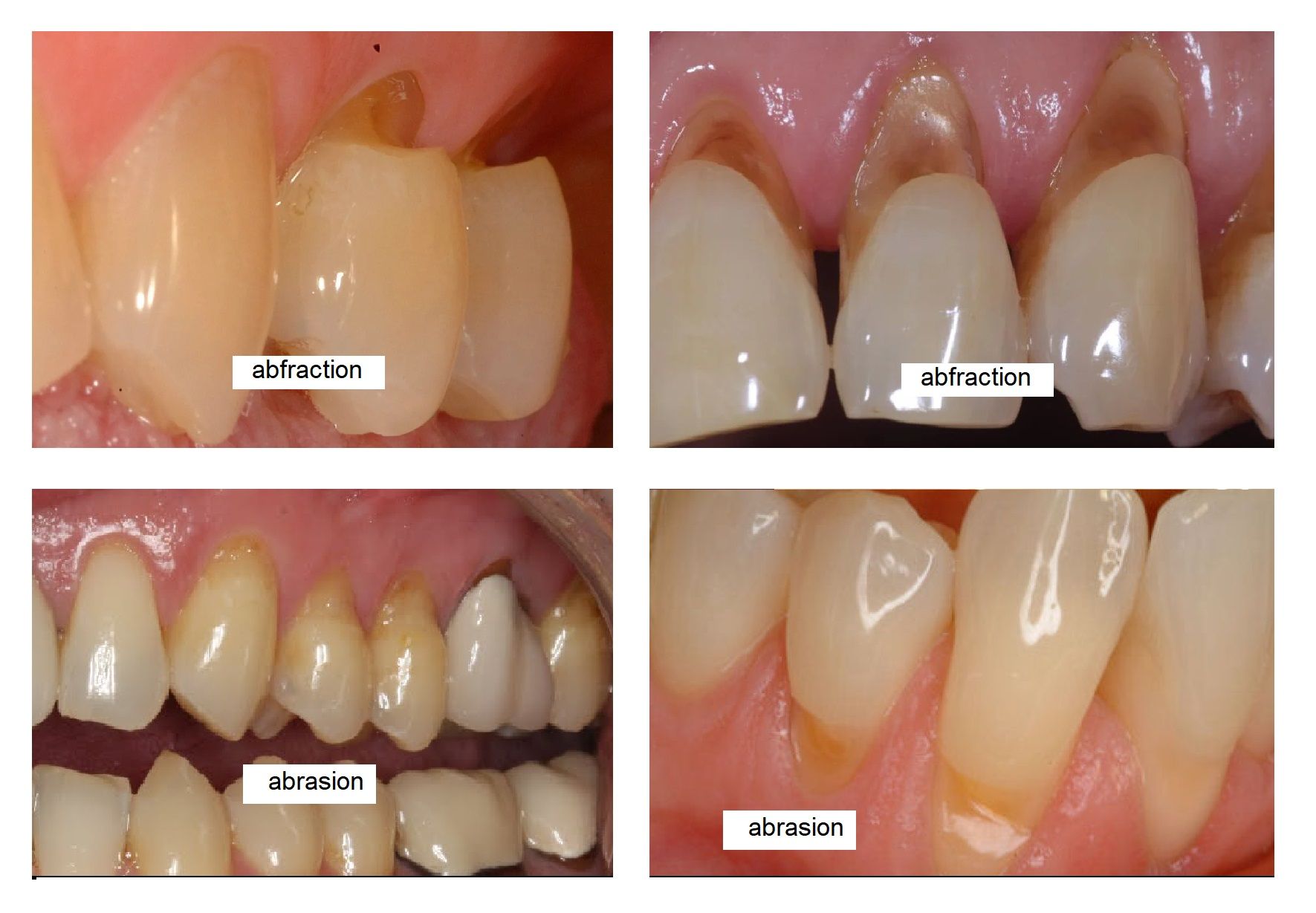 tooth abrasion, erosion, and abfraction