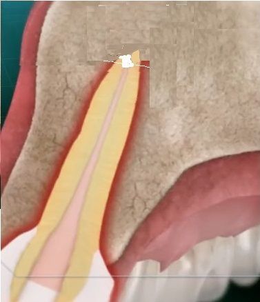 healing period 3-6 months after apicoectomy.