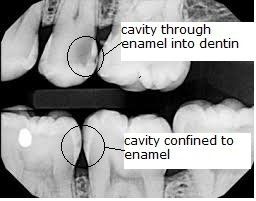 cavities on an x-rays
