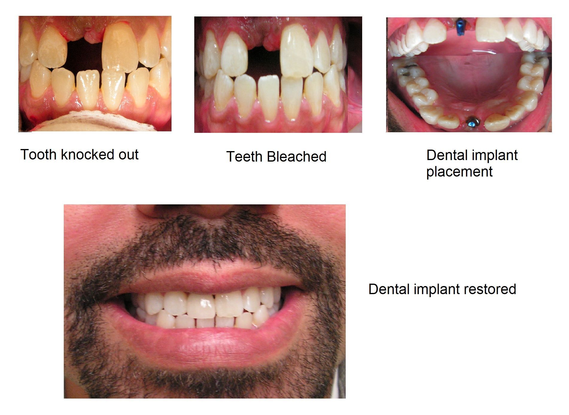 A picture of a man 's teeth before and after dental implant #8. Castellano DMD