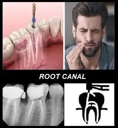 root canal dentistry castellano