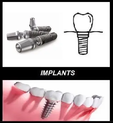implant dentistry castellano
