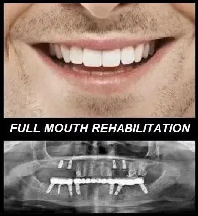 full mouth rehabilitation dentistry castellano
