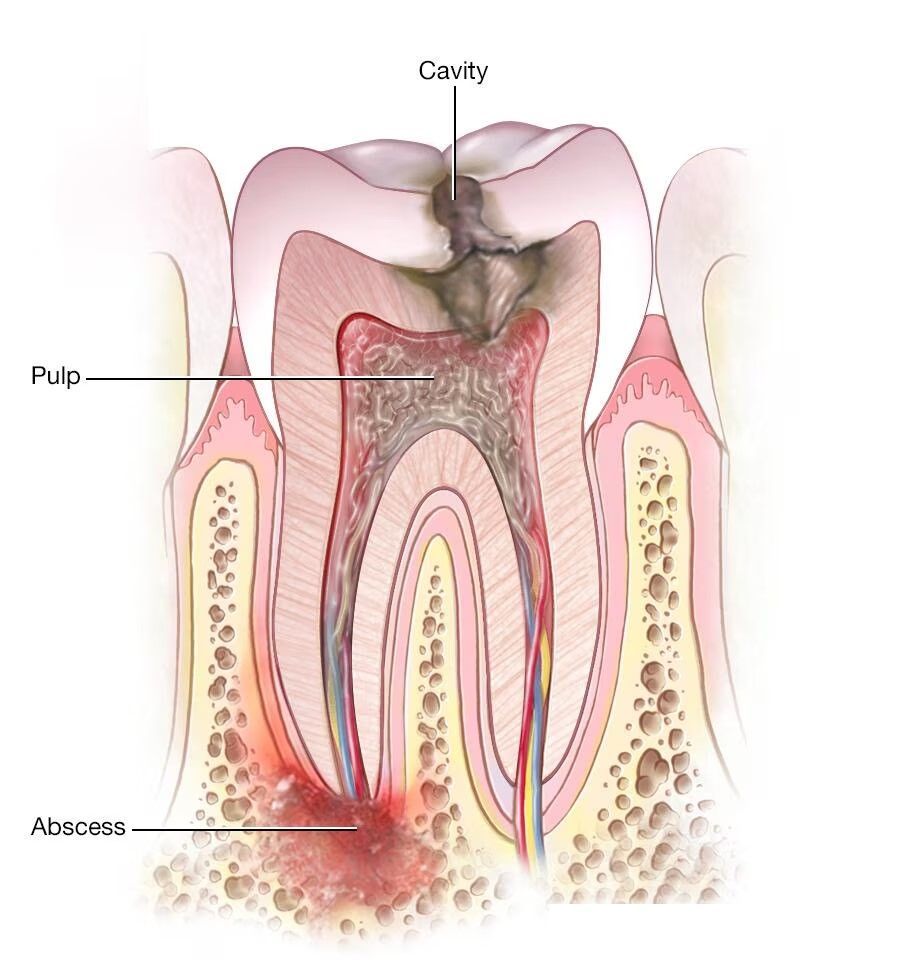 tooth abcess,dentist 33578, castellano dmd