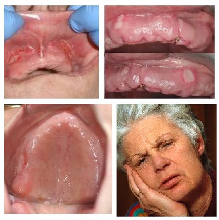 pictures of denture sores, castellano dmd, riveview 33578