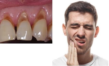 tooth notches at the gum line