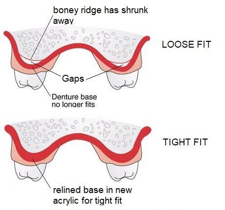 the reason for denture wobble is bone loss.
