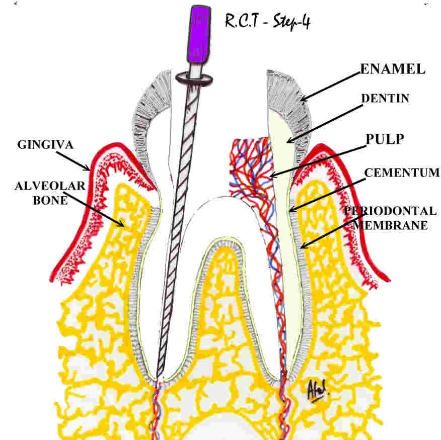 checking for decay using trans- illumination. Chris Castellano DMD, best dentist near me, 33578, Riverview, Fl.  