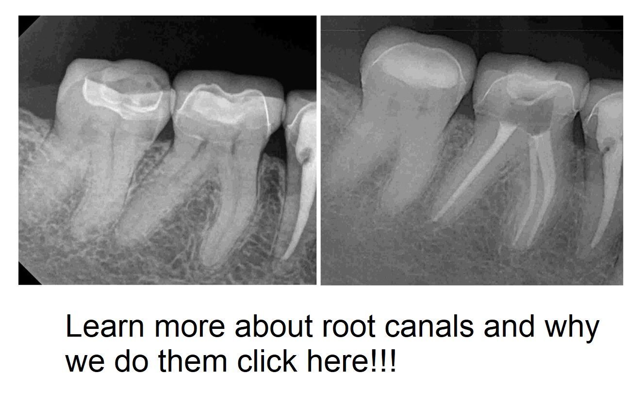 dentist near me, root canal, riverview 33578
