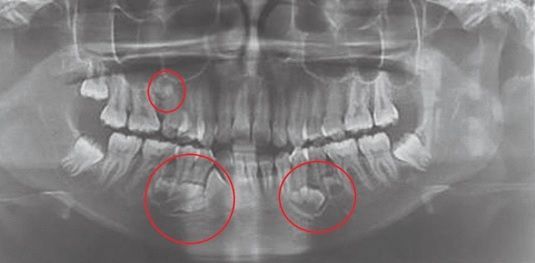 supernumerary teeth, extra teeth, unerupted teeth, odontogenic cysts, follicular cysts, 