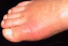 Foot showing signs of gout