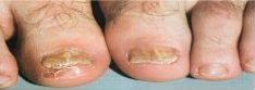 Toenails with  fungal infection 