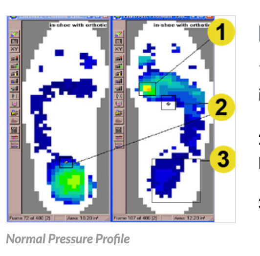 Normal Pressure Profile