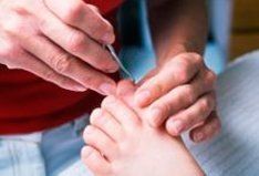 Operating on ingrown nail