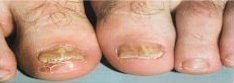 Toenails with fungal infection