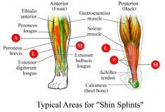 Typical areas for shin splints