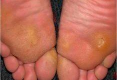 Soles of feet with calluses