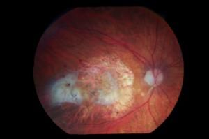 New treatment shows vision benefit in Age Related Macular Degeneration