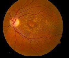 Macular Degeneration successfully treated in Stem Cell Ophthalmology Treatment Study