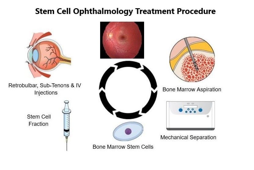 Age-related Macular Degeneration (AMD) Vision Improves with MD Stem Cells Treatment