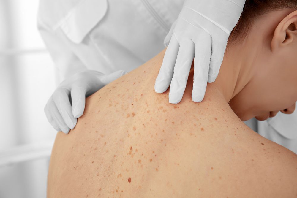 A Close Up of a Person Back With a Doctor Examining It — Coastal Skin & Laser in Noosa, QLD