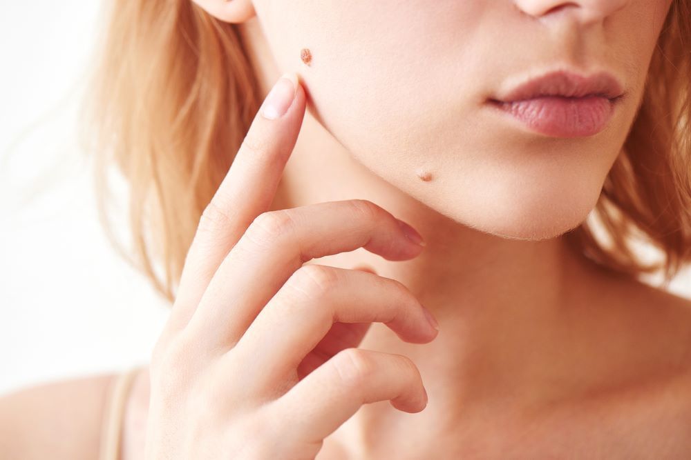 A Close Up of a Woman 's Face With a Mole on It — Coastal Skin & Laser in Caloundra, QLD